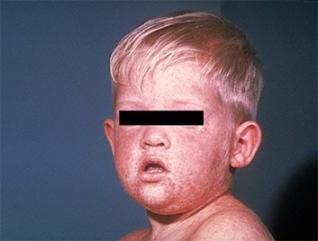 An image of a child with measles. The rash covers the lower half of his face including chin.