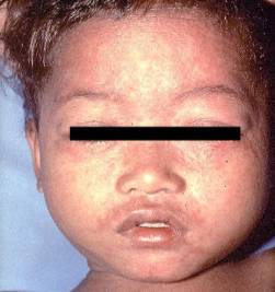 Young child with measles
