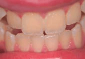 Teeth showing tooth decay